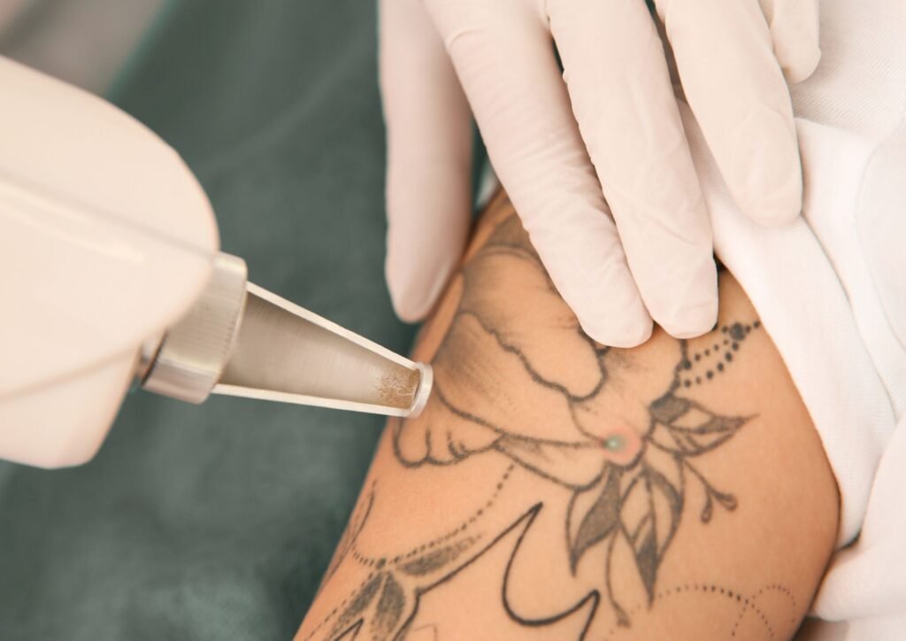 Tattoo Laseren