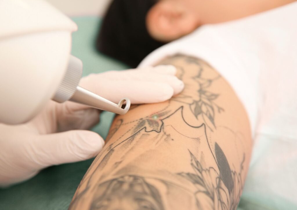 Tattoo Laseren