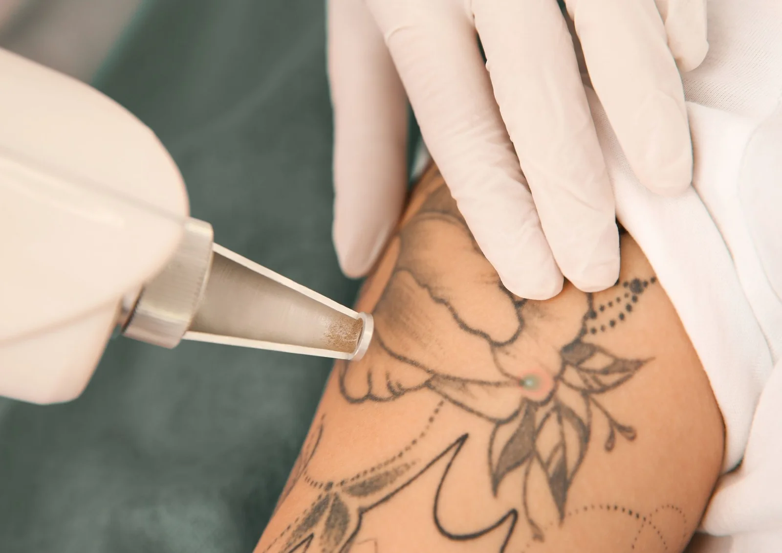 Proces van tattoo laseren en huidherstel
